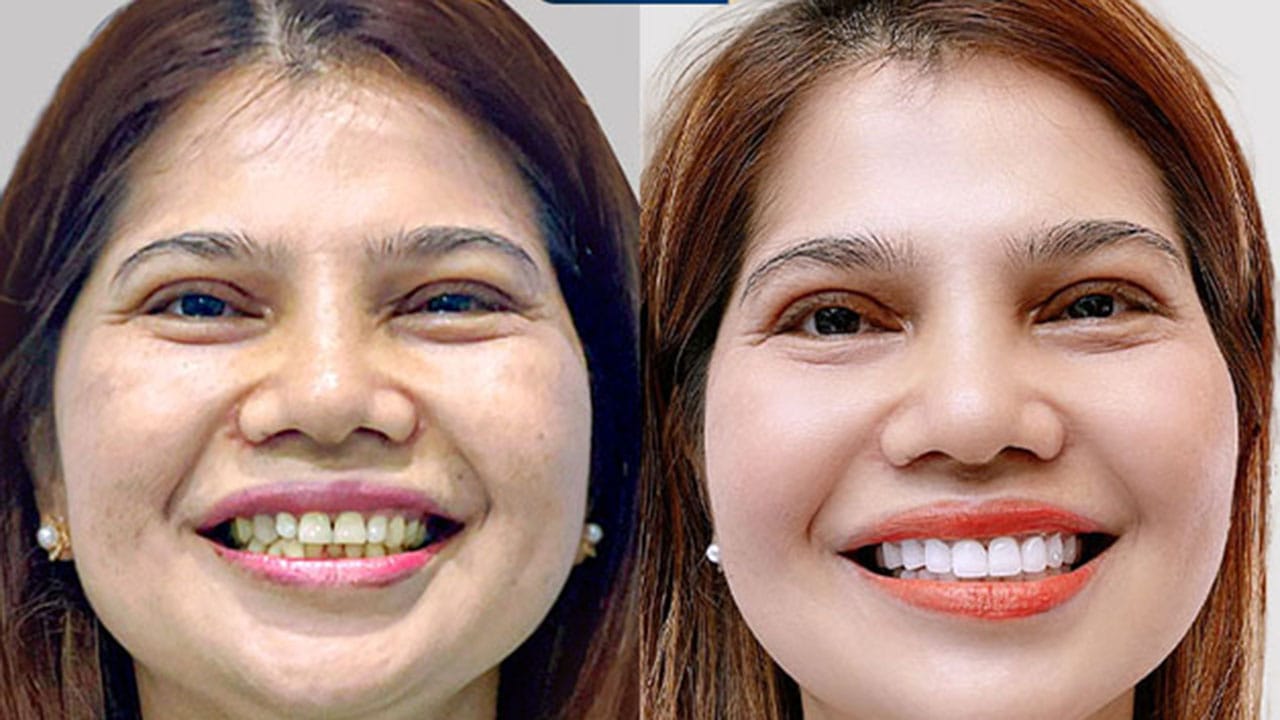 Lý do Việt Kiều lựa chọn làm răng tại Việt Nam 