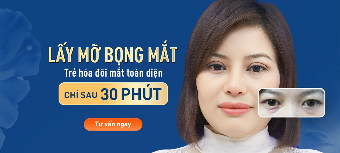 Mở góc mắt – Bệnh viện thẩm mỹ KANGNAM