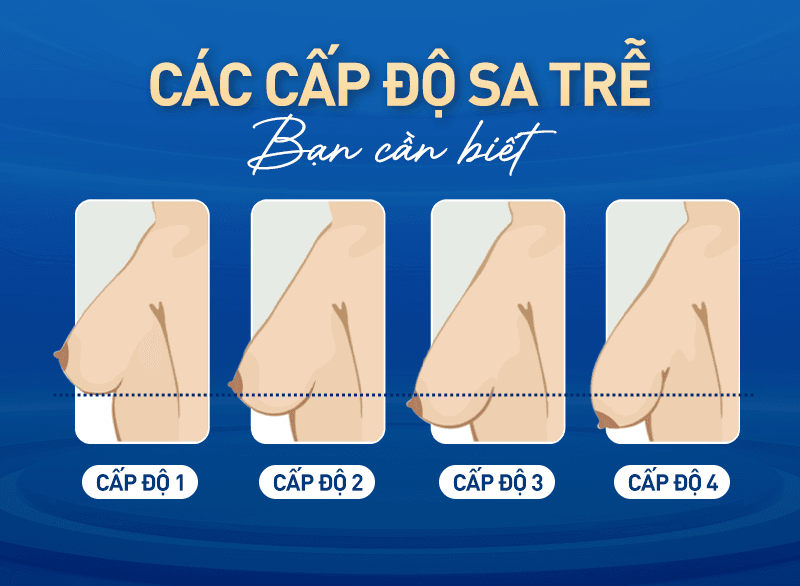 Các cấp độ sa trễ ở phụ nữ