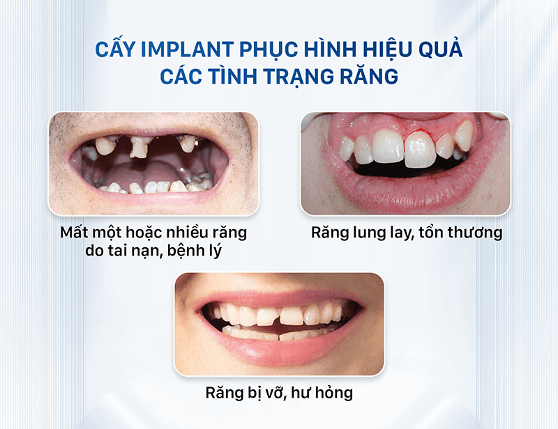 Những trường hợp nên cấy Implant