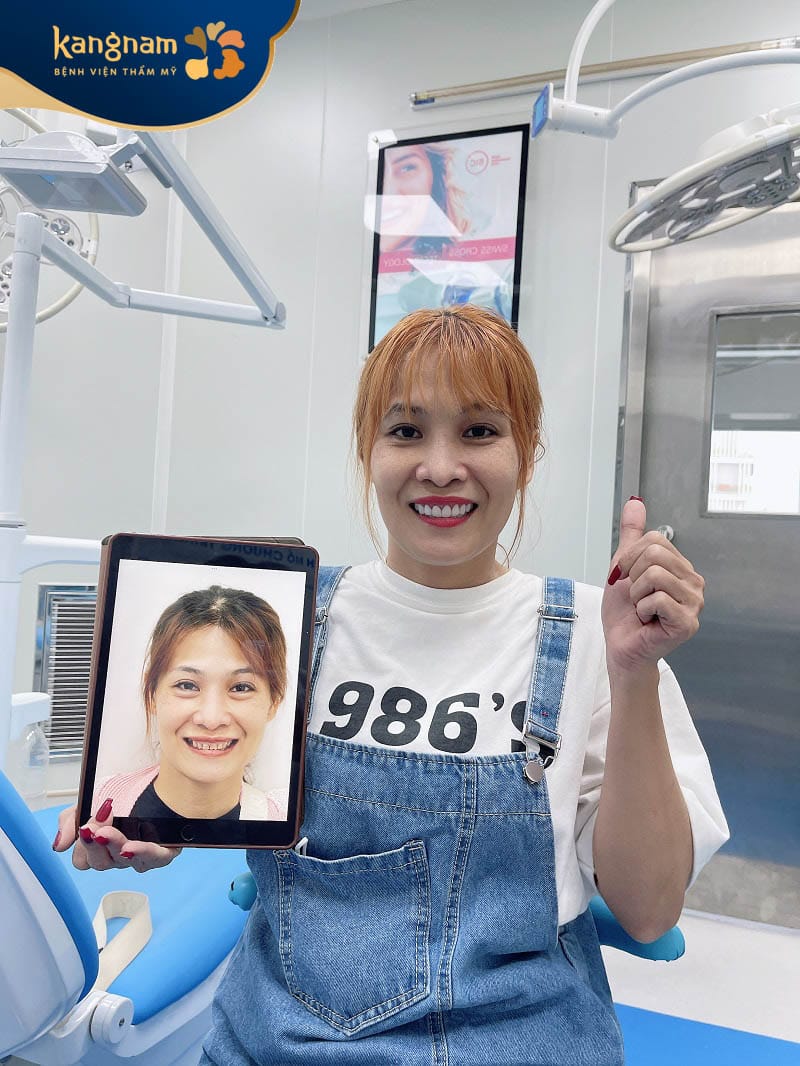 Dán sứ duy trì độ bền cao, lâu năm