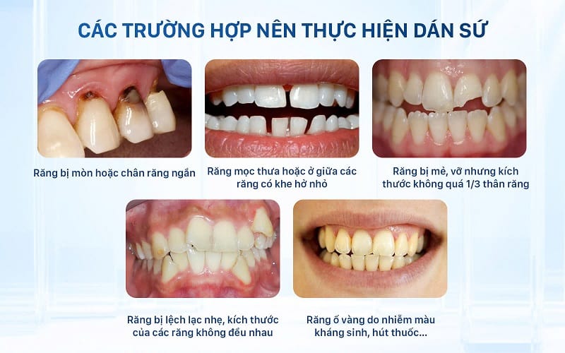Những trường hợp gặp tình trạng răng bị mòn chân răng, răng thưa, răng mẻ nên thực hiện dán sứ