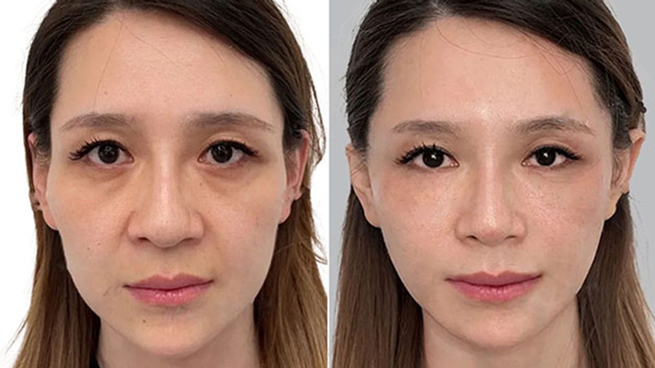 Căng chỉ da – Bí quyết trẻ hóa ‘thần kỳ’ không phẫu thuật