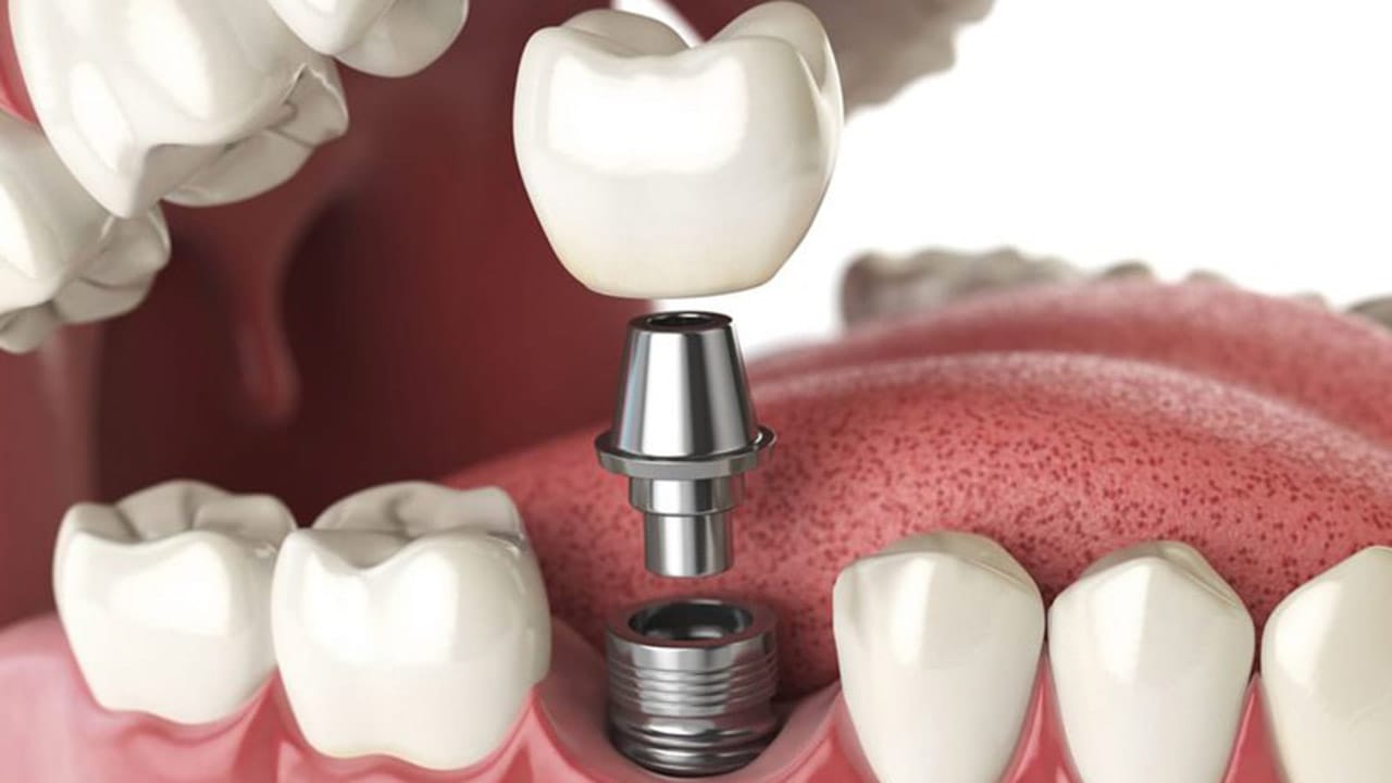 Cấy Implant: Giải pháp phục hình răng an toàn và bền vững
