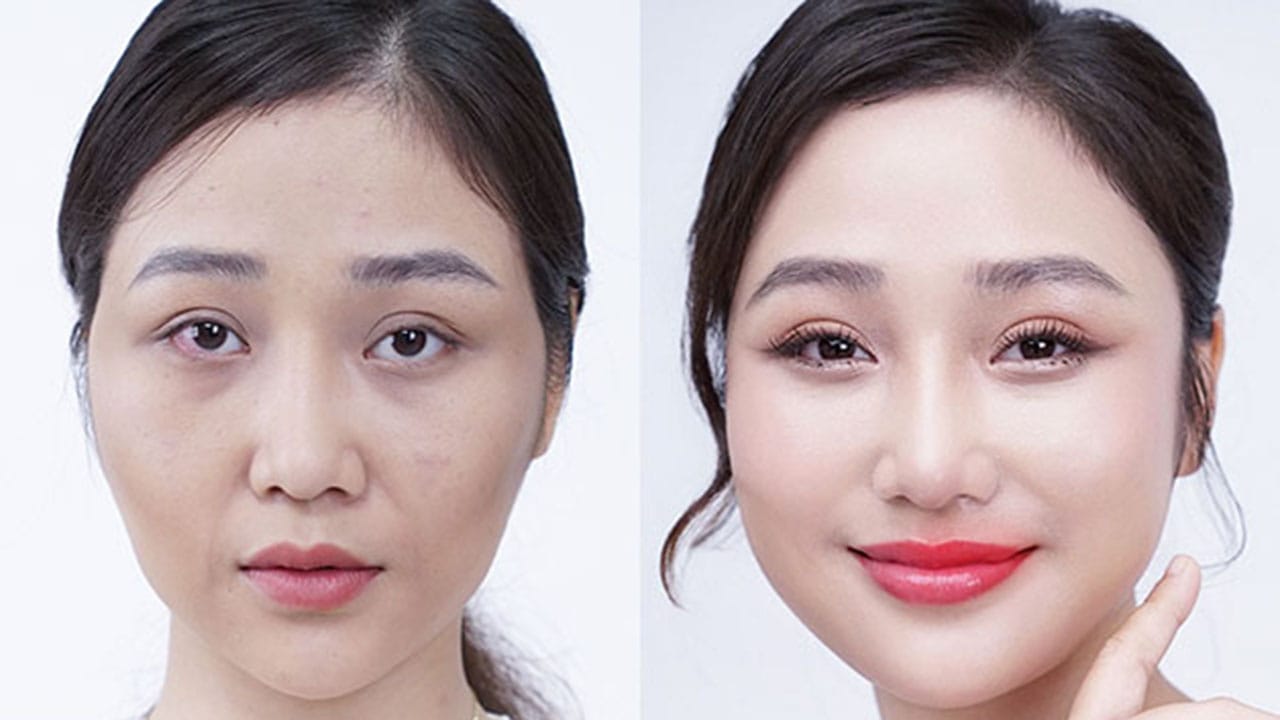 Cấy mỡ mặt – Giải pháp sở hữu khuôn mặt trẻ trung