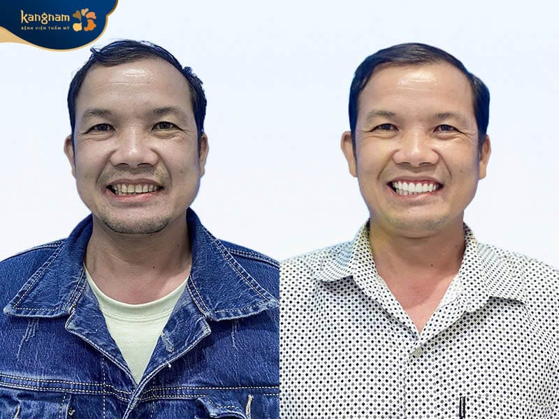 Khách hàng sở hữu nụ cười tươi hơn sau khi thực hiện dán sứ tại Kangnam