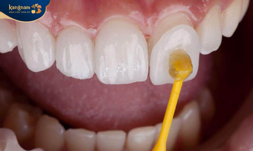 Dán sứ dùng mặt dán làm bằng sứ có độ dày chỉ từ 0,3 – 0,5 mm