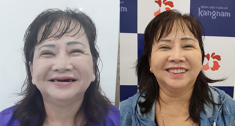 Trồng răng Implant phục hình răng đã mất, bền đẹp, tự nhiên như răng thật