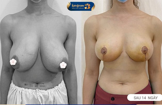 Treo sa trễ giúp nâng cao bầu ngực