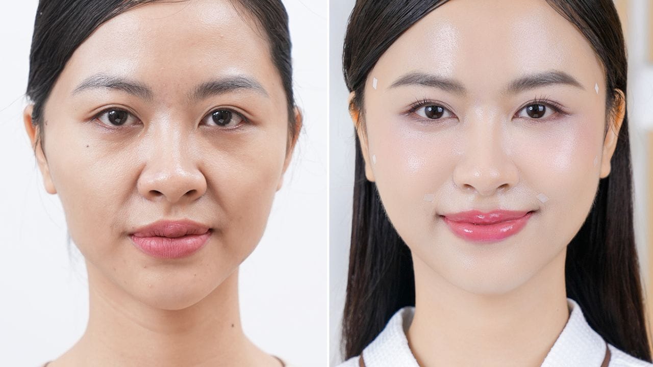 Tiêm filler có hại về sau không