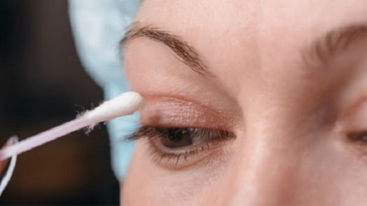 Bôi thuốc chống sẹo sau cắt mí bao lâu