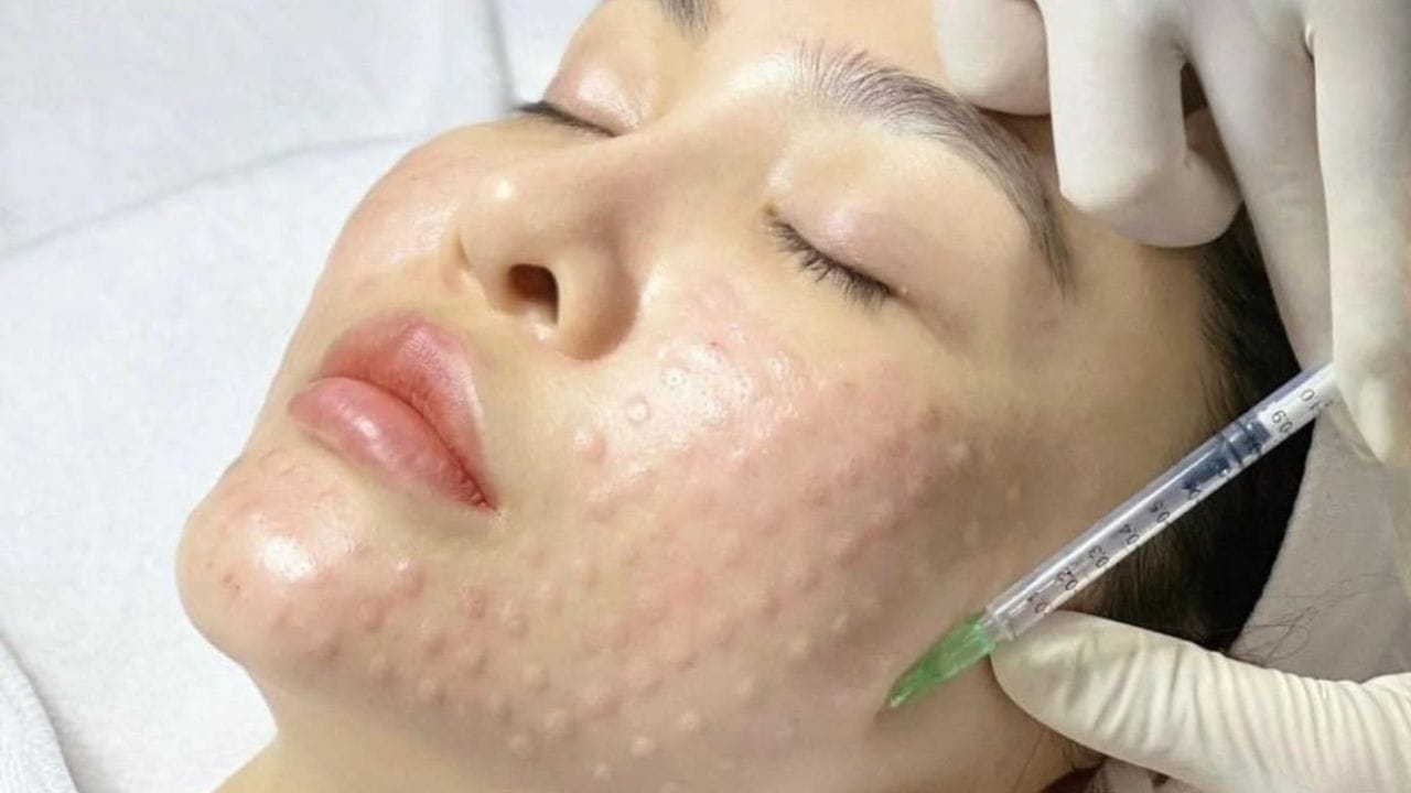 Tiêm meso tại Bệnh viện Da liễu giá bao nhiêu