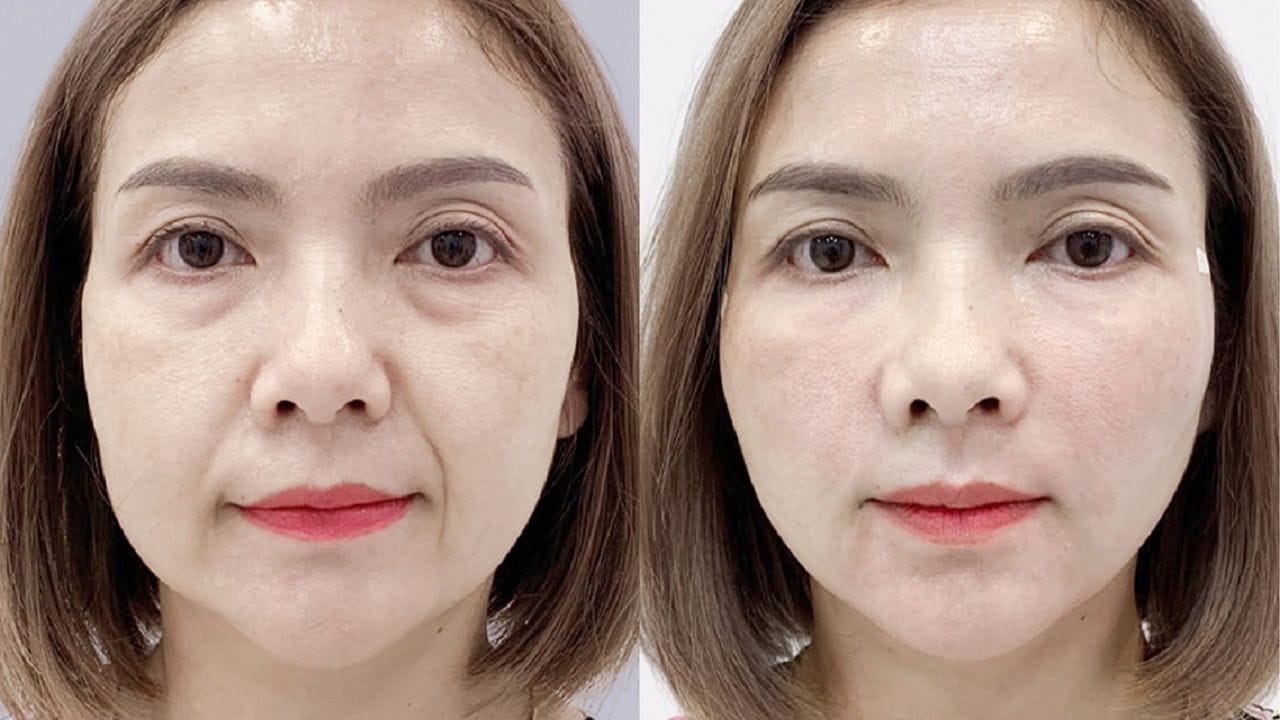 Chi phí cho 1 lần cấy chỉ bao nhiêu tiền