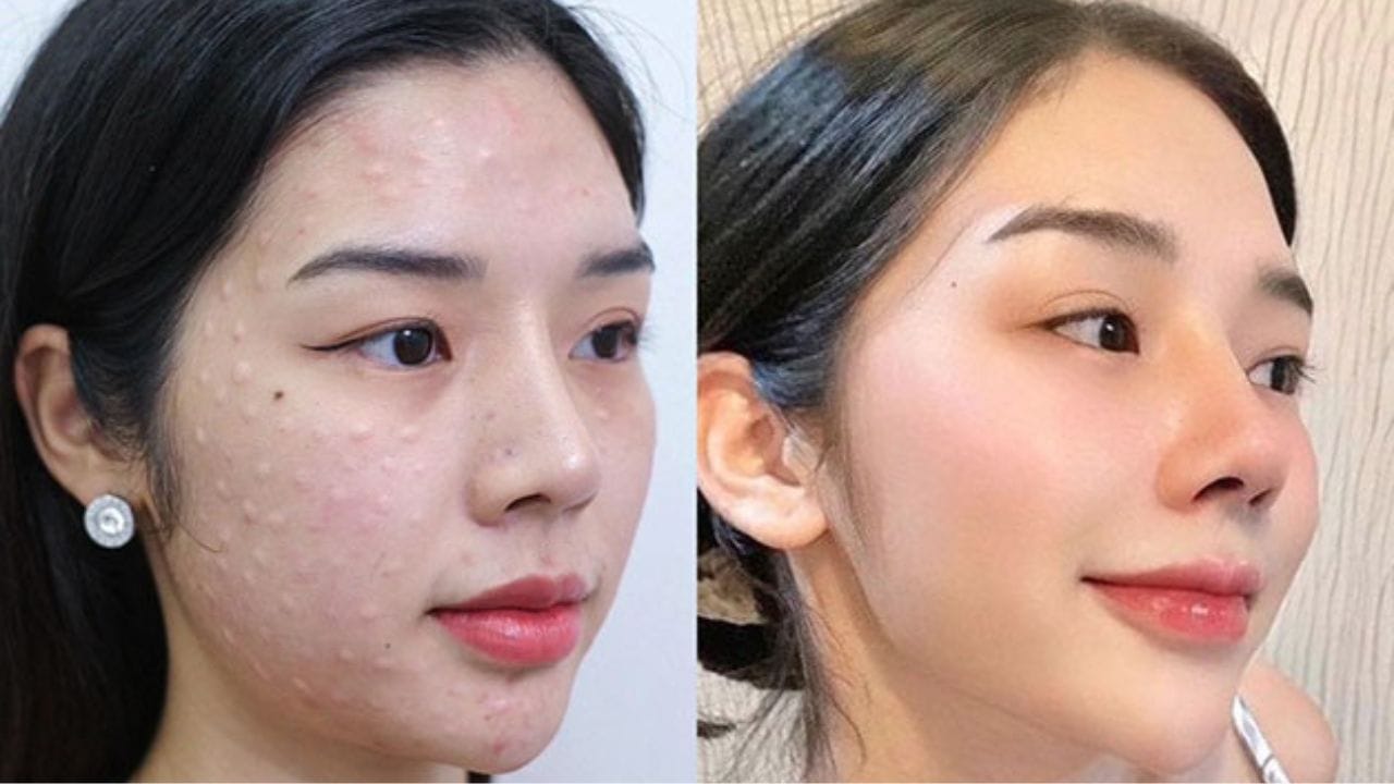 Cấy meso Extra bao nhiêu tiền?Những yếu tố ảnh hưởng đến chi phí