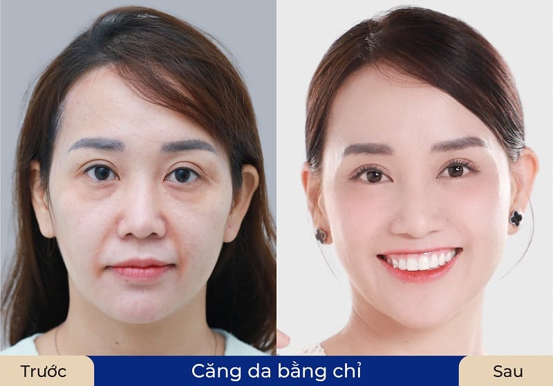 Với những khách hàng có tình trạng lão hóa nặng hoặc cấy chỉ toàn mặt sẽ có chi phí cao hơn