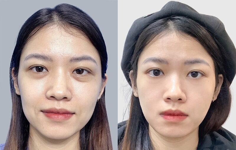 Sau cấy chỉ da mặt khách hàng sở hữu gương mặt săn chắc, làn da căng bóng