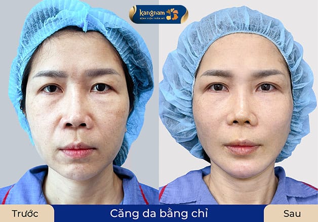 Sau khi căng chỉ collagen, làn da hồi phục sau 5 - 7 ngày