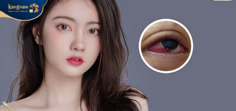 Tác hại của mở rộng góc mắt là nhiễm trùng