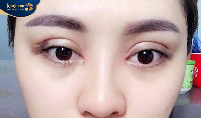 Mí mắt không được cân đối, ảnh hưởng đến tính thẩm mỹ