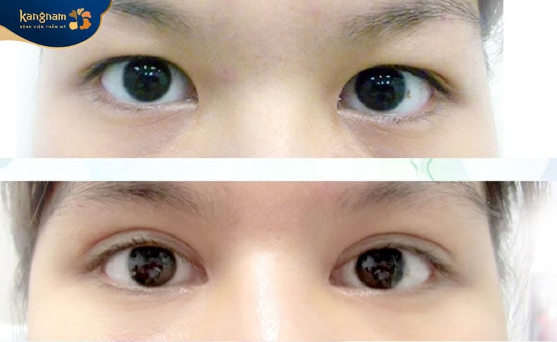 Thực hiện mở rộng góc mắt không đúng cách có thể để lại sẹo