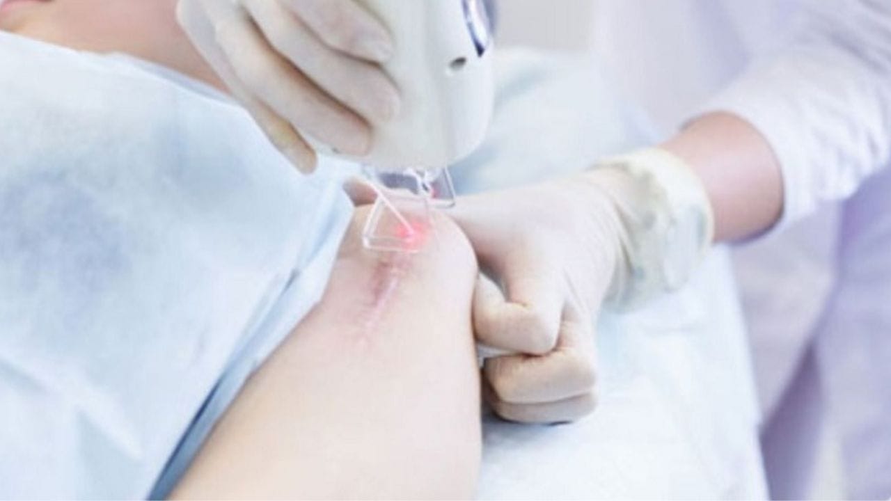 Top 7 cách trị sẹo lồi lâu năm hiệu quả