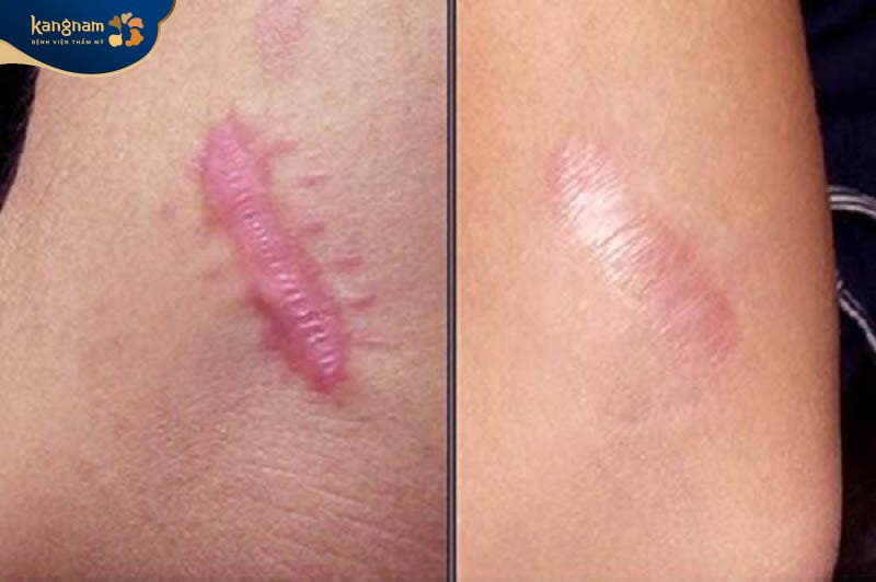 Sẹo lồi có thể điều trị những không thể hết hoàn toàn