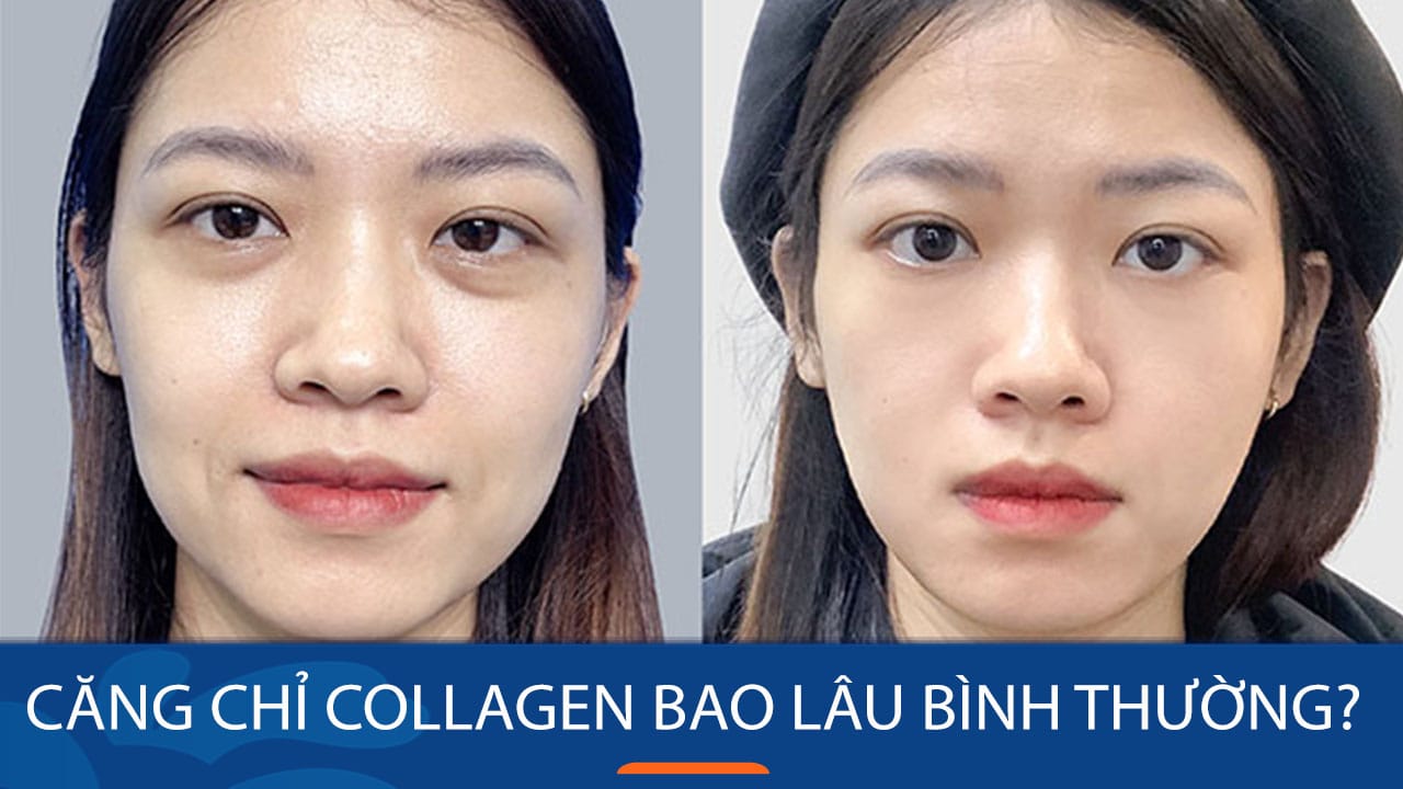 Căng chỉ collagen bao lâu trở lại bình thường? Giải đáp từ chuyên gia