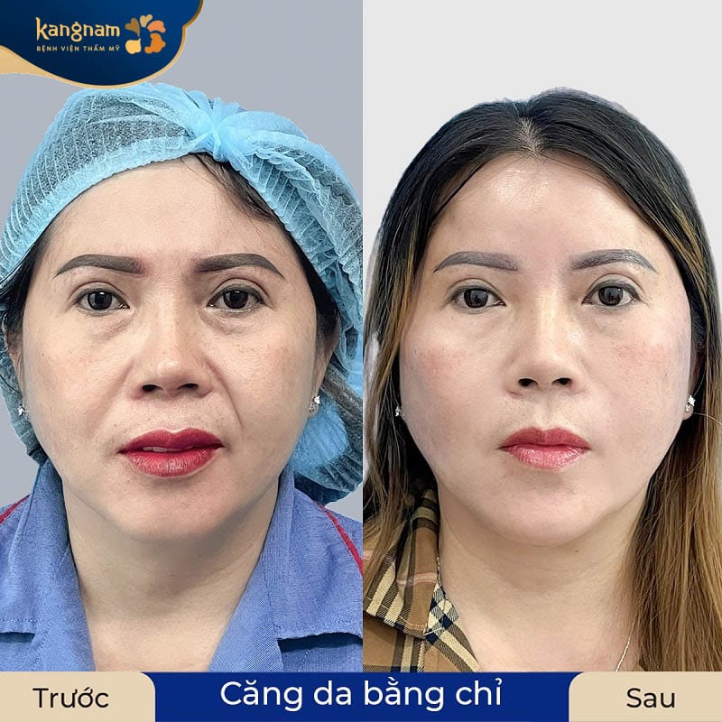 Các sợi chỉ cần thời gian để thích nghi với làn da