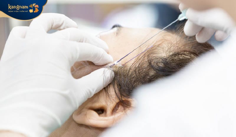 Tay nghề của bác sĩ ảnh hưởng đến hiệu quả cấy chỉ