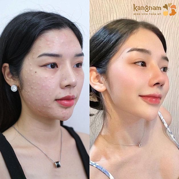 Chi phí cấy meso extra có sự thay đổi dựa vào nhiều yếu tố