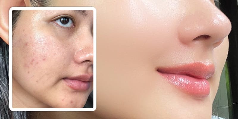 Cấy meso có thể thực hiện cho những trường hợp da bị lão hóa, mụn, chảy xệ