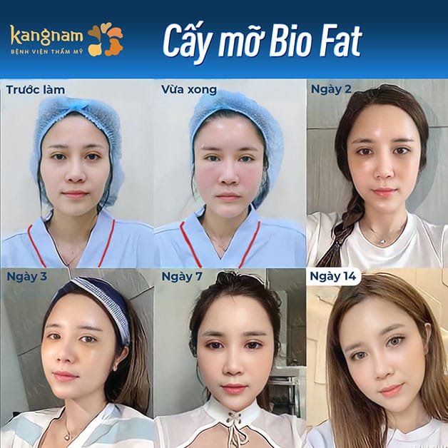 Mỡ không giữ được hoàn toàn sau khi cấy vào cơ thể, vì khi được đưa vào vị trí mới