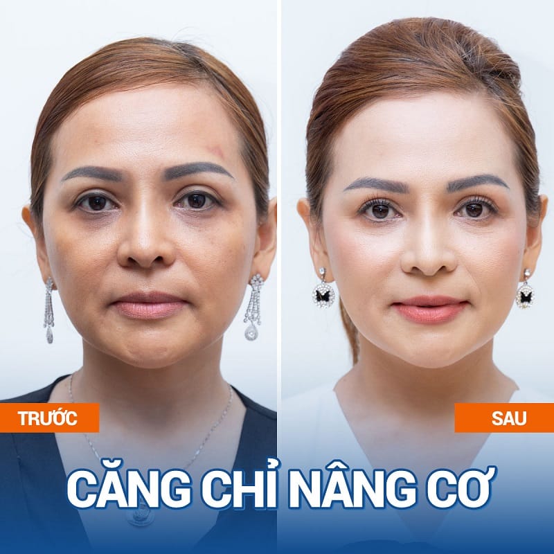 Căng chỉ giúp khắc phục tình trạng da nhăn nheo, chảy xệ