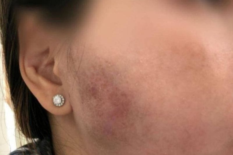 Vùng da sưng đỏ sau tiêm là biến chứng nguy hiểm