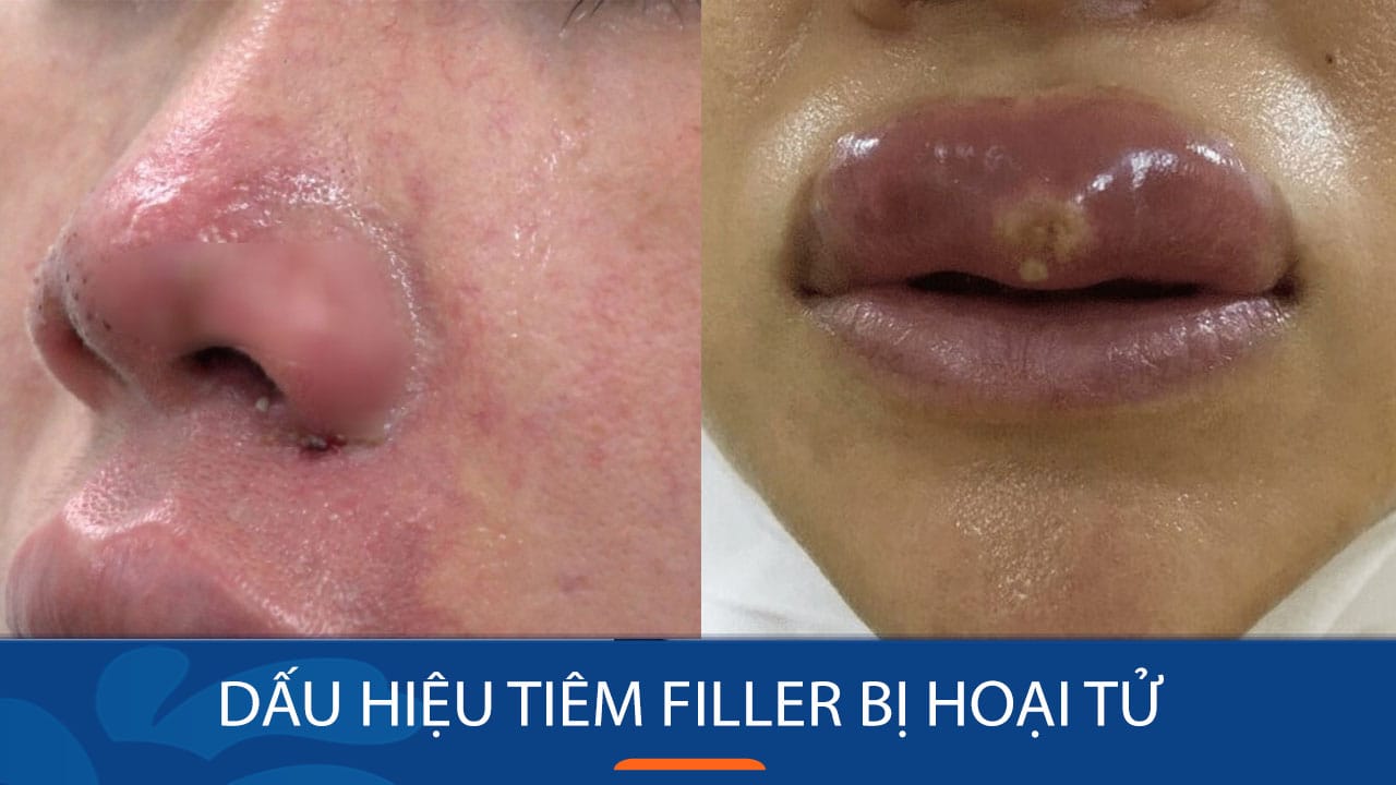 Nhận biết 7 dấu hiệu tiêm filler bị hoại tử trước khi quá muộn
