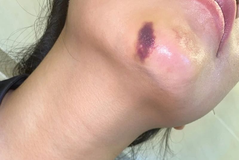 Tiêm filler bị hoại tử ảnh hưởng đến sức khỏe và thẩm mỹ