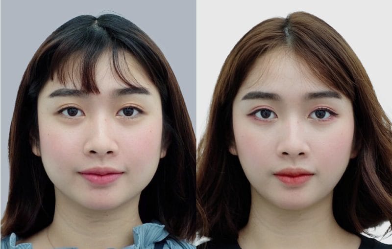 Tiêm botox không gây hại đến sức khỏe