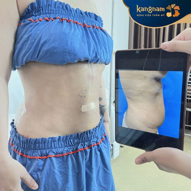 Chi phí giảm mỡ bụng tùy vào lượng mỡ cụ thể