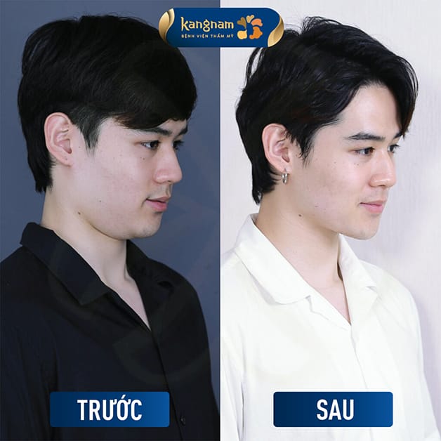 Giảm mỡ nọng cằm giúp gương mặt cân đối