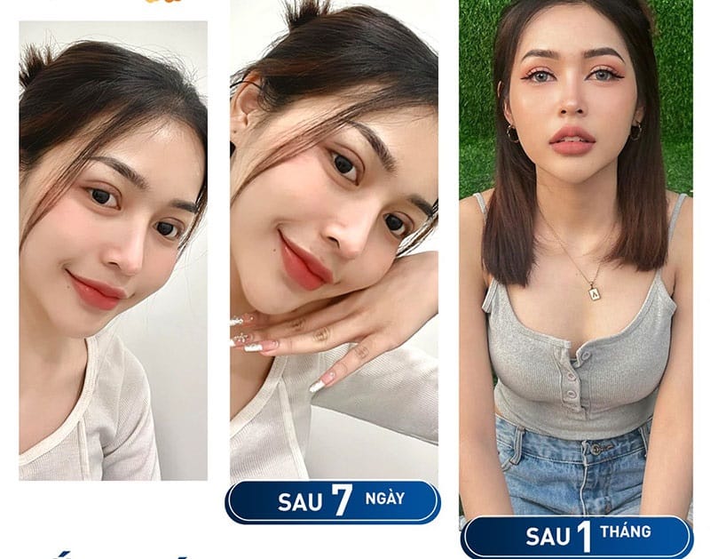 Nếp mí cân đối và hài hòa sau 1 tháng cắt mí