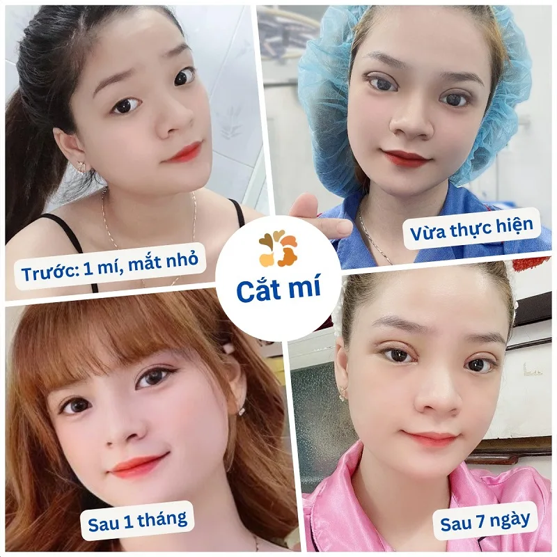 HÌNH ẢNH CẮT MÍ SAU 10 NGÀY GIÚP THEO DÕI DIỄN BIẾN SƯNG NỀ