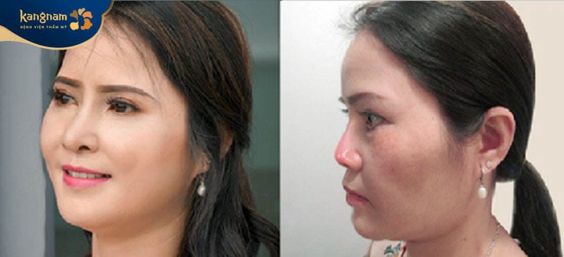 Sống mũi giảm độ cao khi về già