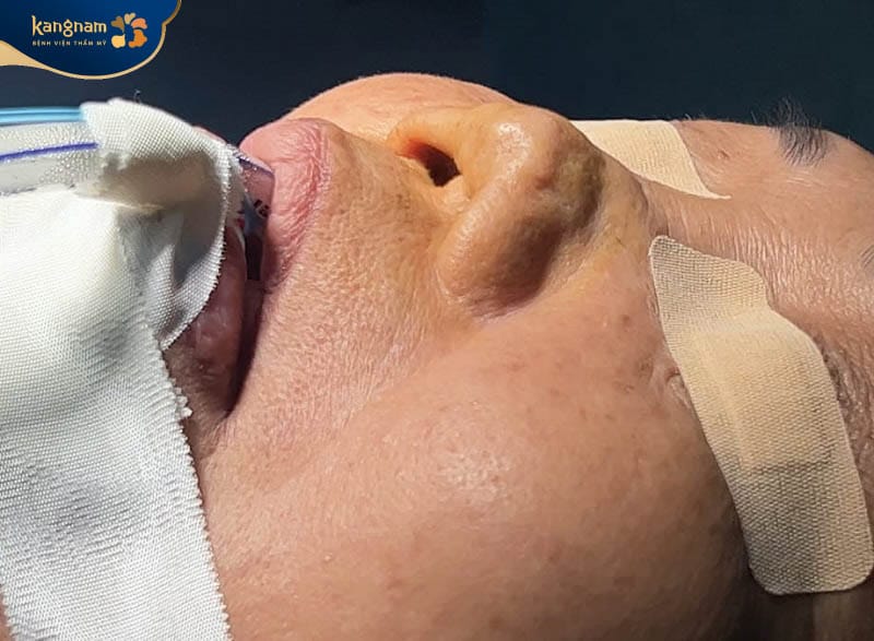 Mũi gặp tình trạng biến dạng khi về già