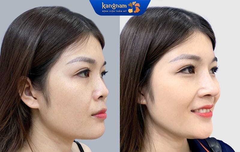 Nâng mũi về già sẽ không gây ra biến chứng nếu khách hàng thực hiện tại cơ sở thẩm mỹ uy tín