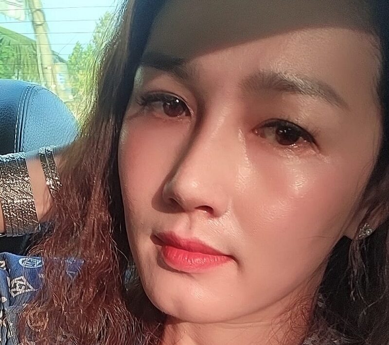 Sau nhiều năm mũi không thay đổi khi thực hiện nâng mũi đúng cách