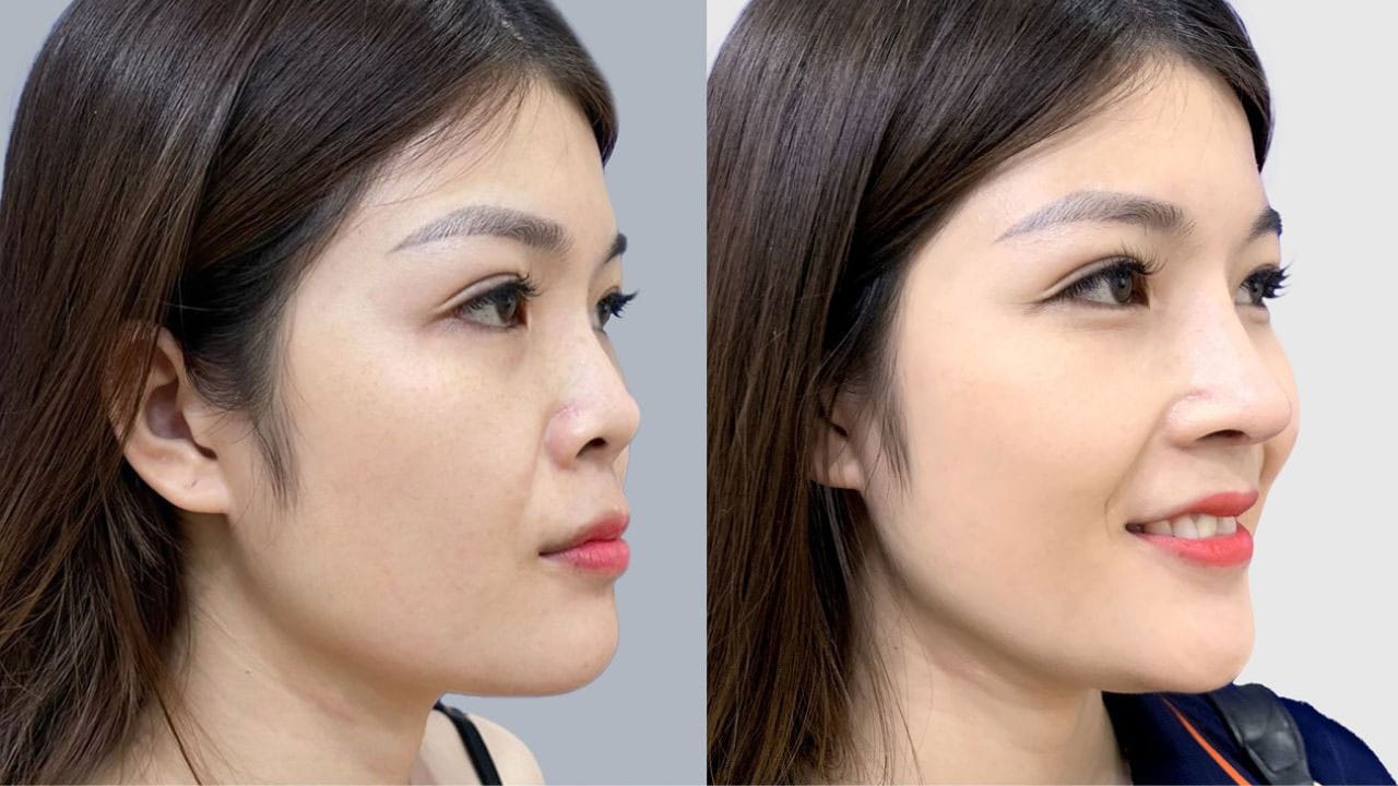 Hình ảnh nâng mũi khi về già trông thế nào