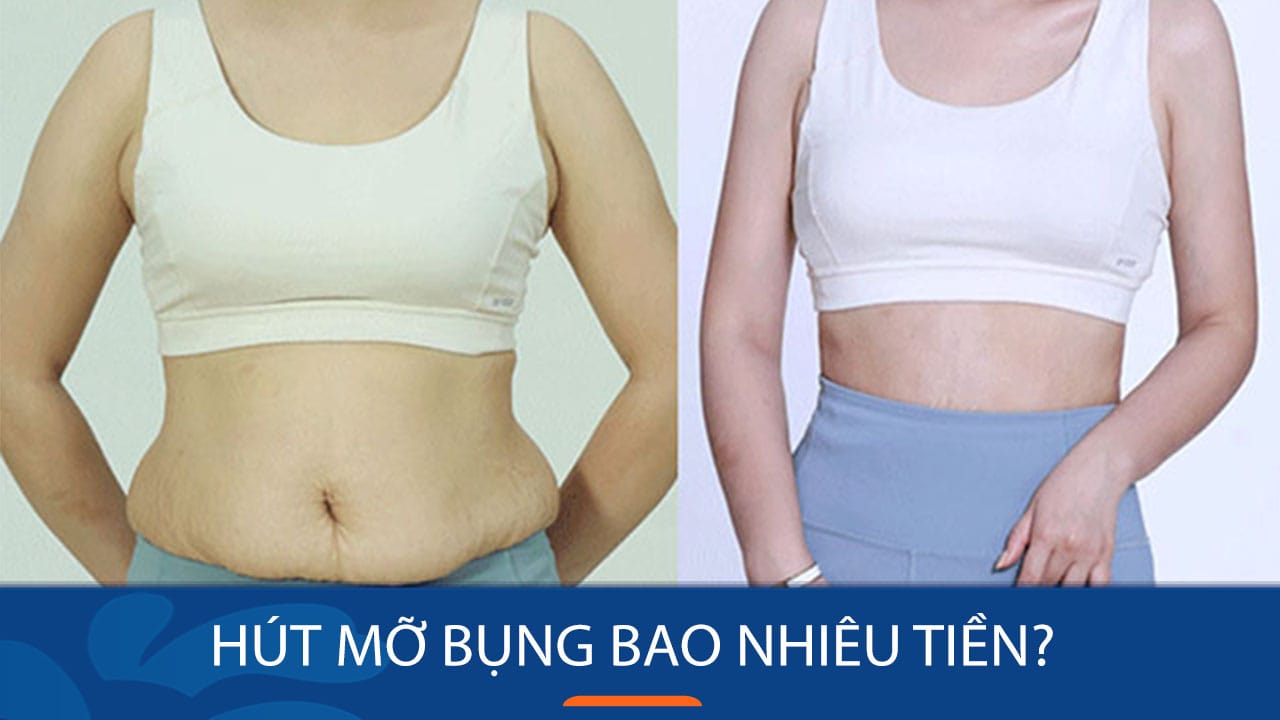 Hút mỡ bụng bao nhiêu tiền? Cập nhật bảng giá mới nhất