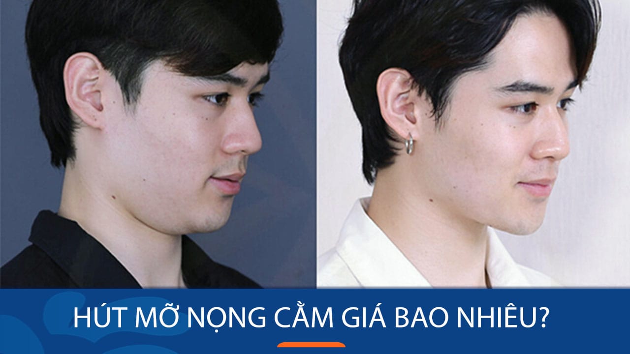 Hút mỡ nọng cằm giá bao nhiêu tại các thẩm mỹ viện uy tín?