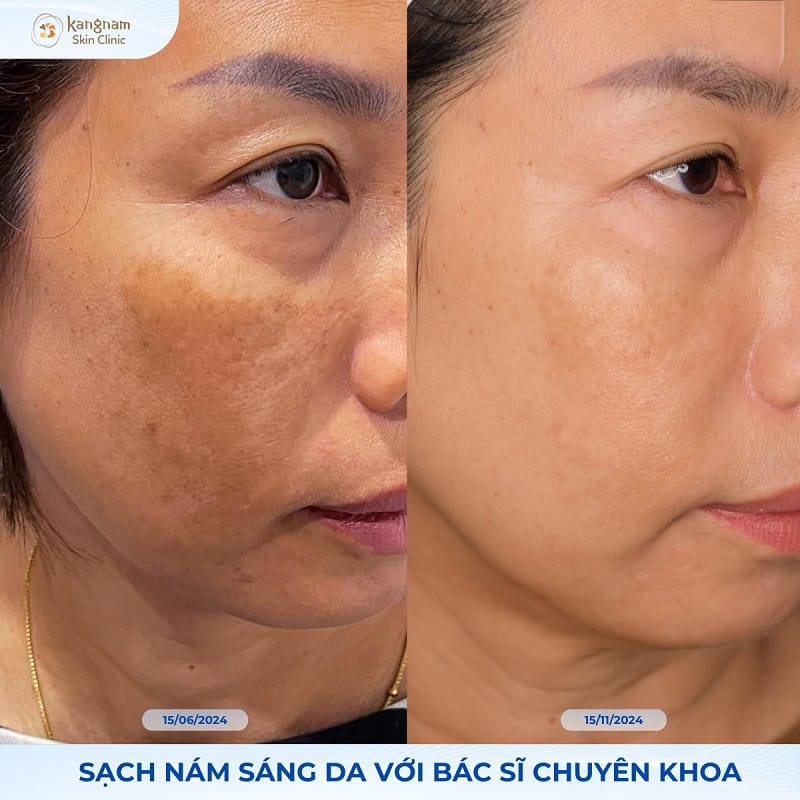 Nếu làn da khách hàng có nhiều dấu hiệu lão hóa, chi phí điều trị sẽ cao hơn