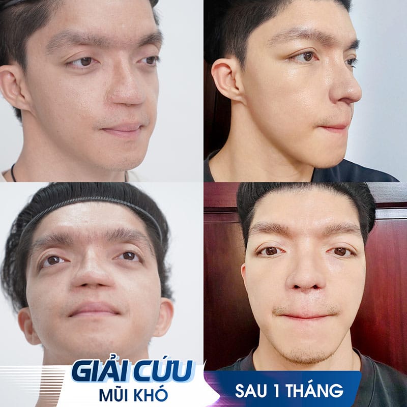 Chi phí sửa mũi tùy thuộc vào tình trạng mũi